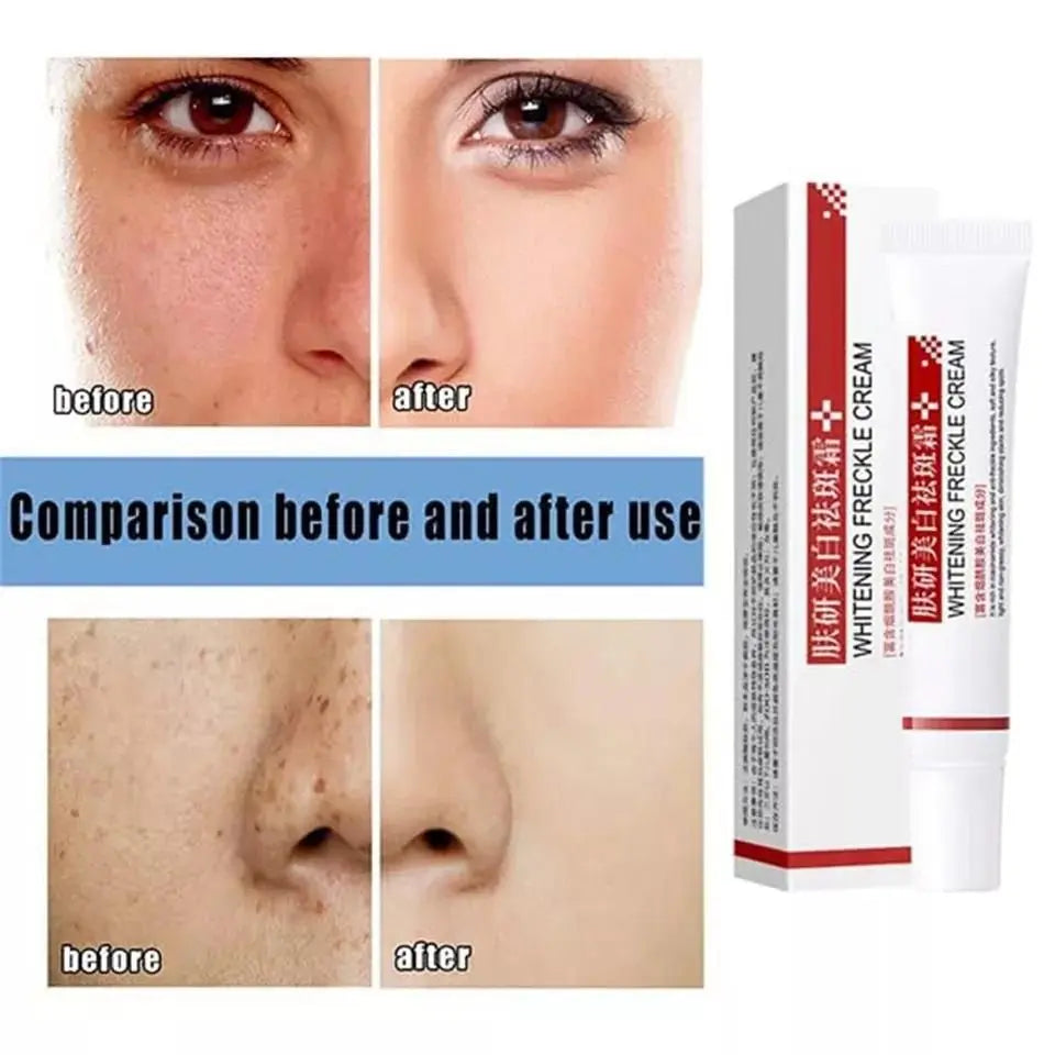 Effective Whitening Freckle Cream - DECORATION HUB